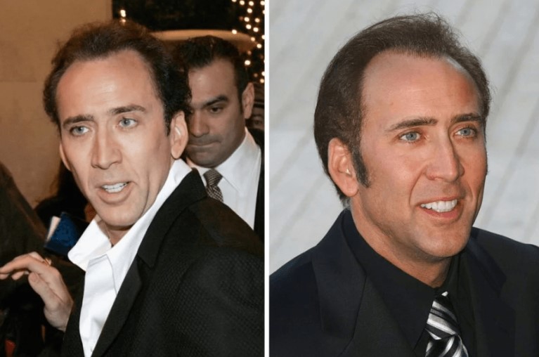 12 famosos que se han sometido a trasplantes capilares - Nicolas Cage