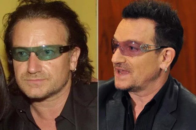 12 famosos que se han sometido a trasplantes capilares - Bono U2