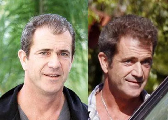 12 famosos que se han sometido a trasplantes capilares - Mel Gibson