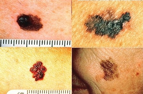 cancer en la piel